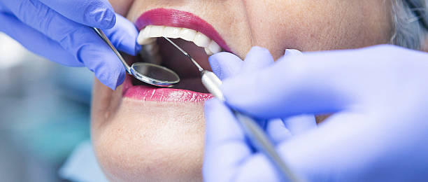 Emergency Dental Filling Replacement in SC
